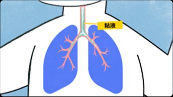 気道に大量の粘液がたまり、呼吸が苦しくなる様子の画像